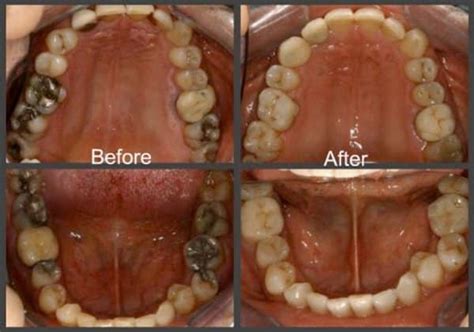 Dental Inlays And Onlays At Dentists Esthetix Dental Spa NY