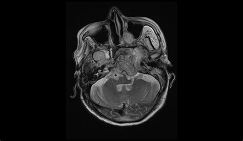 Clival Chordoma Mri Radiology Article On Clival Chordoma