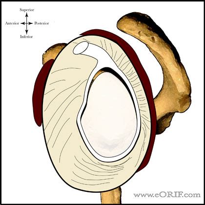 SLAP Tear Classification | eORIF