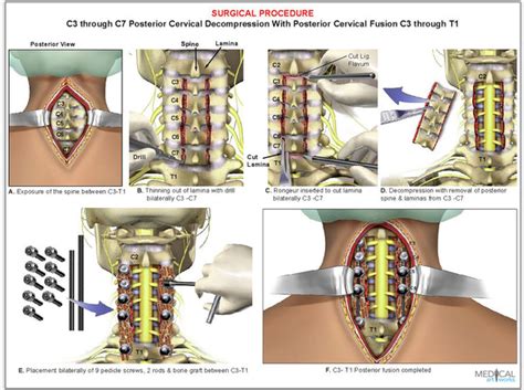 4 level - C3-C7 cervical spine decompression surgical procedure ...