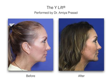 Y Lift Liquid Facelift Results Can Last Anywhere Between Years