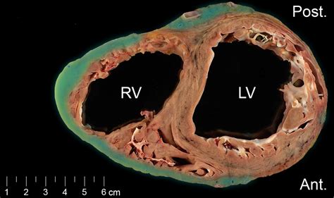 Arrhythmogenic Right Ventricular Cardiomyopathy Histology