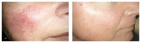 Vbeam Perfecta Before And After Contour Dermatology