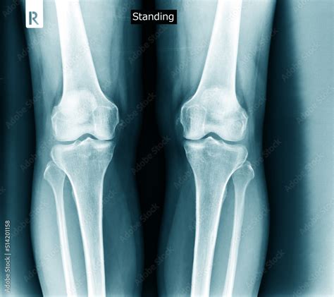 knee joint x ray degeneration Stock Photo | Adobe Stock