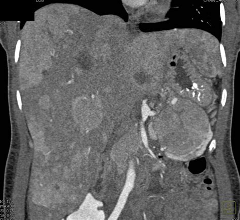 Islet Cell Tumor Neuroendocrine Tumor Of The Pancreatic Tail With Liver Metastases Pancreas