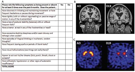 Lewy Body Dementia Practical Neurology