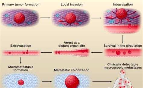 The Process of Tumor Cell Metastasis in the Body | Download Scientific Diagram