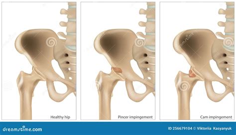 Illustration Of The Femoroacetabular Impingement. Different Of The Cam Impingement And Pincer ...