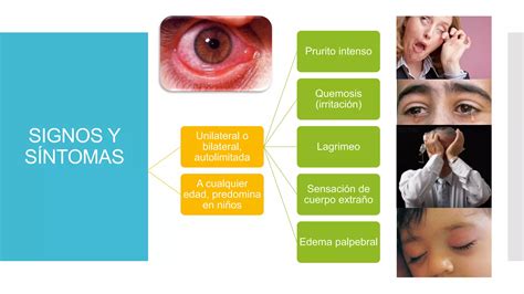 Conjuntivitis Al Rgica Ppt Descarga Gratuita