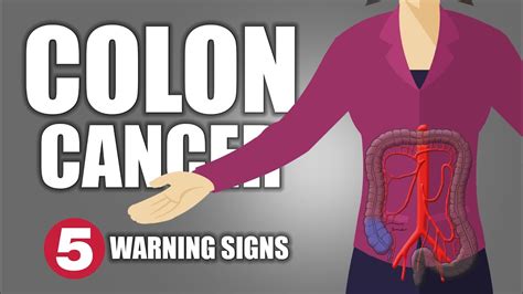 5 Warning Signs Of Colon Cancer You Should Not Ignore Cancer Warning Signs Signs Colon