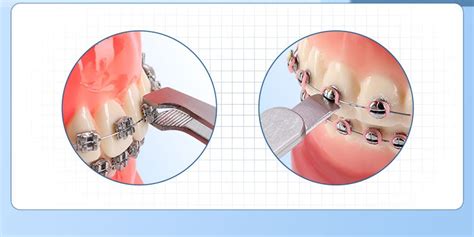 China Pinzas De Soporte Dental Ortodoncia Acci N Inversa Instrumentos