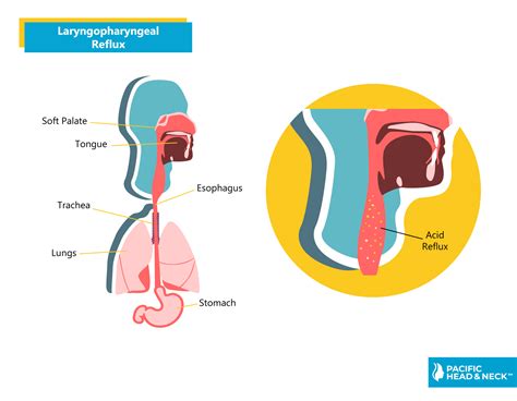 Laryngopharyngeal Reflux Acid Reflux Pacific Head And Neck