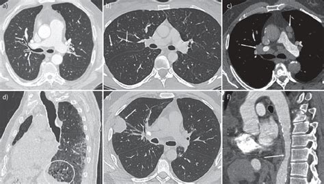 Various Imaging Patterns Of Immunoglobulin G4 Related Disease Thoracic