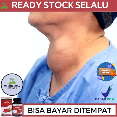 Obat Benjolan Di Leher Obat Untuk Benjolan Di Leher Obat Pembengkakan