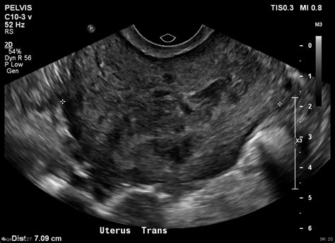 Uterine Fibroids Ultrasound