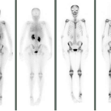 M Tc Methyl Diphosphonate Whole Body Scan Showing Increased Blood