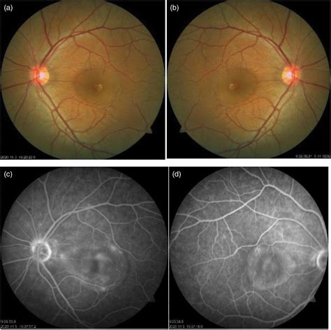 A Case Report Of Systemic Lupus Erythematosus Combined With Central