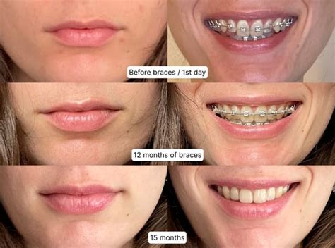 Before And After 15 Months Of Braces For Class22 Malocclusion Deep