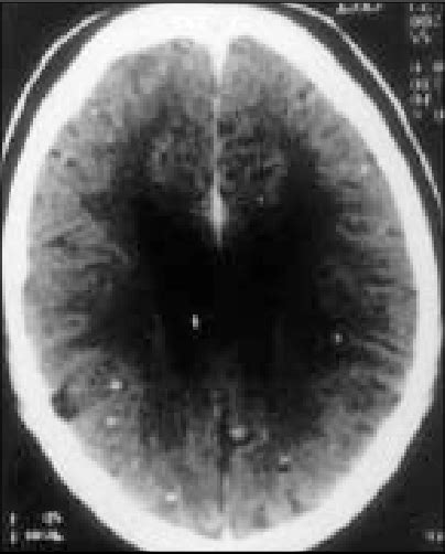 Figure 1 From Kluver Bucy Syndrome An Experience With Six Cases