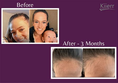 4 Ways To Fight Hair Loss As A New Mom Kiierr Laser Hair Caps Hair