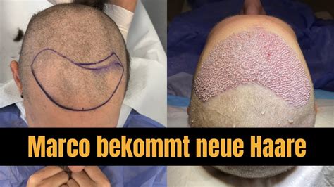 Haartransplantation Deutschland Ergebnis Und Erfahrung YouTube