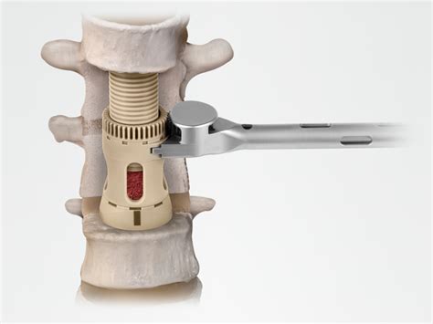 Fortify™ Product Page Expandable Technology