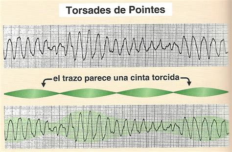 Diferencia Entre Ventricula Y Auricula Clearryte