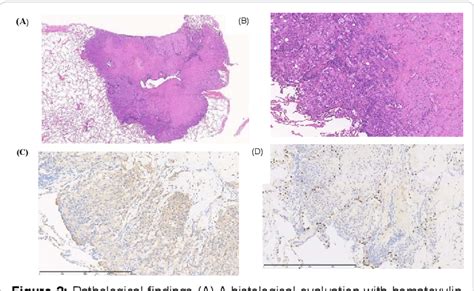 Figure 1 From A Case Of Pulmonary Epithelioid Hemangioendothelioma With