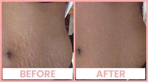 Laser Stretch Mark Removal In Chandigarh