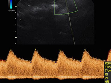 Chographie Du Premier Trimestre Avec Mesure De La Clart Nucale