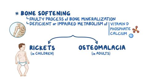 Osteomalacia and rickets: Video, Anatomy & Definition | Osmosis