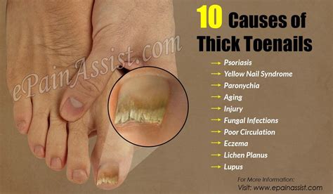 10 Causes Of Thick Toenails Thick Toenails Toe Nails Nail Remedies