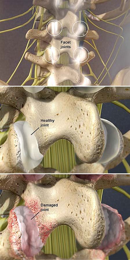 Facet Joint Syndrome Central Coast Orthopedic Medical Group