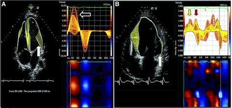 Role Of Tissue Doppler And Strain Echocardiography In Current Clinical