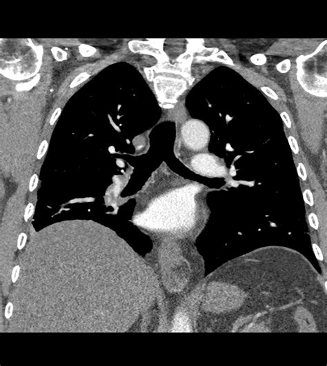 Pulmonary Embolism And Infarction In The Setting Of Factor V Leiden