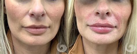 Filler Treatment Before And After Lip Augmentation Smile Lines