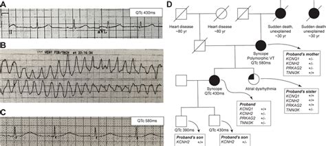 Electrocardiogram Ecg Tracings And Pedigree A Ecg From Proband