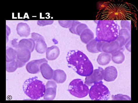 Hematología Fichas Leucemia Linfocitica Aguda L 3