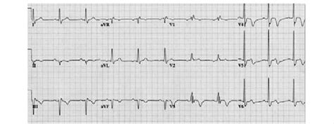 Wellens syndrome. Wellens syndrome refers to specifi c ECG ...