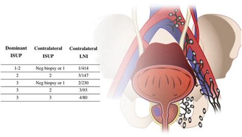 Unilateral Pelvic Lymph Node Dissection In Prostate Cancer Patients Diagnosed In The Era Of