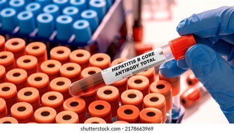 Hepatitis B Core Antibody Total Test Stock Photo 2178663969 | Shutterstock