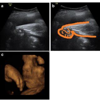 (PDF) Prenatal sonographic diagnosis of fetal valproate syndrome: a ...