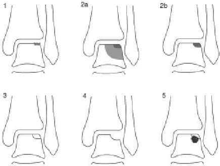 Osteochondral Defect Classification Mri