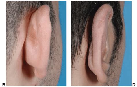 Otoplasty Best Surgeon Ear Surgery NYC Otoplasty Chapter 49