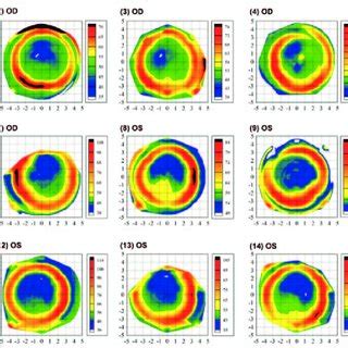 Epithelial Thickness Maps Of 15 Randomly Selected Eyes Each Plotted