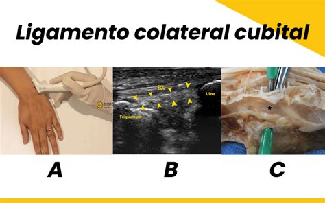 Ligamento Colateral Radial Y Ligamento Colateral Cubital Ecografía Y Anatomía Tempo Formación