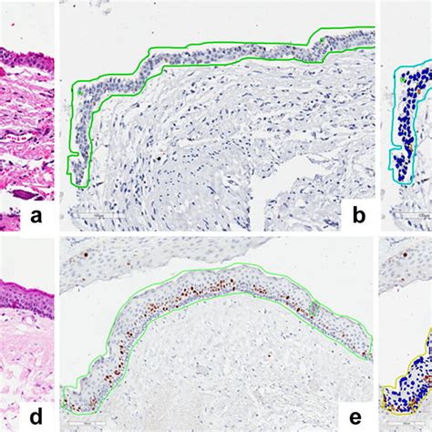 Immunohistochemical Analysis Of Ki 67 Expression In The Epithelial