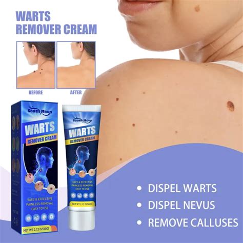 Hold Live Warts Remover Original Cream Warts Removal Mole Removal Cream