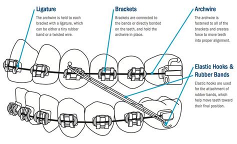 How To Put Rubber Bands On Braces Triangle – Dunya led