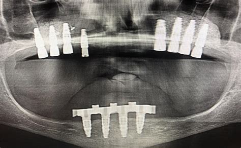 After Bilateral Sinus Lifts